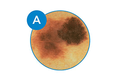 Melanoma