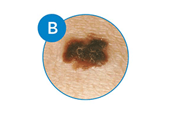 melanoma