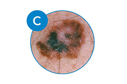 melanoma