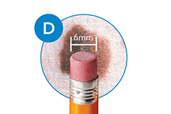 melanoma