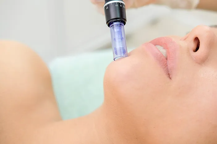 microneedling